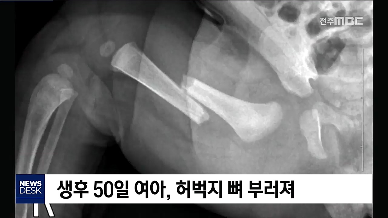 생후 50일 딸 학대한 친부 구속