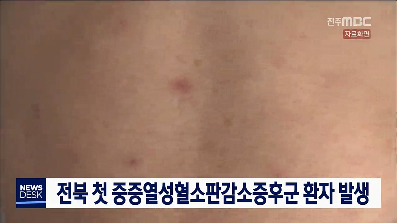 중증열성혈소판감소증후군 환자 전북 첫 발생