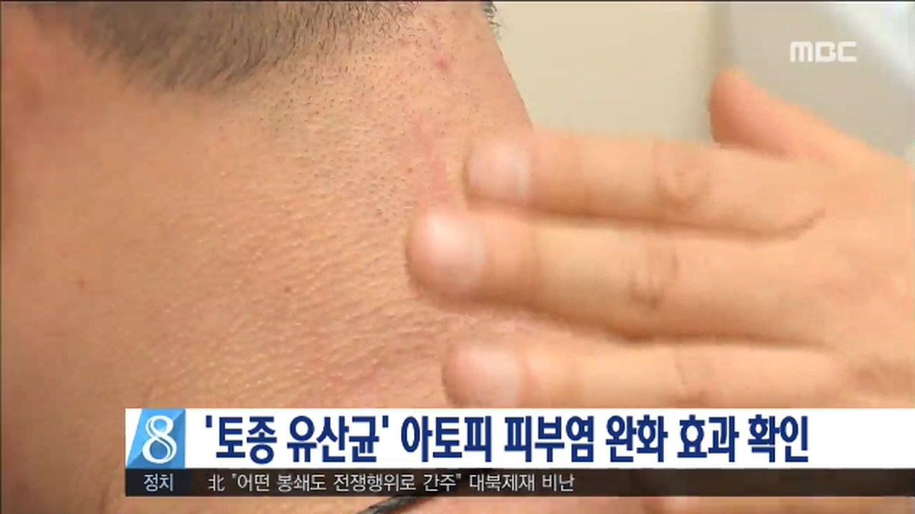 토종 유산균 아토피 피부염 완화 확인